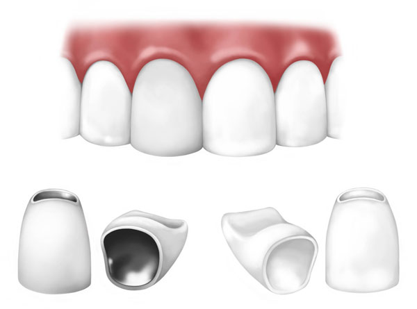 types of dental crowns