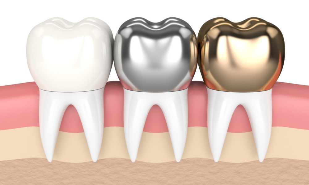 Which Type of Tooth Crown is Best?