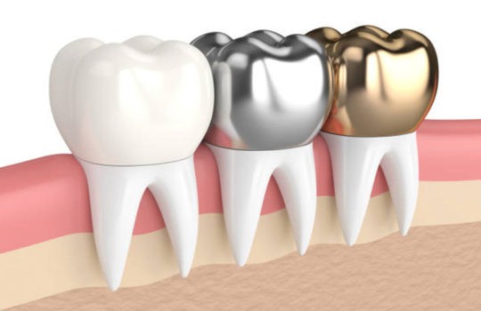 dental crowns san diego